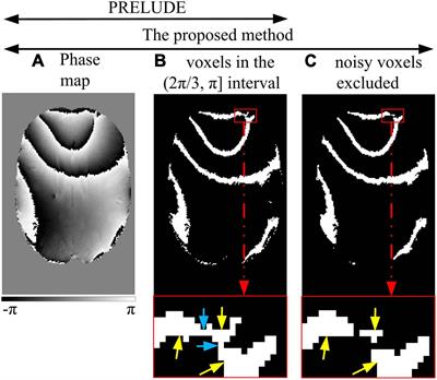 A new 3D phase unwrapping method by region partitioning and local polynomial modeling in abdominal quantitative susceptibility mapping